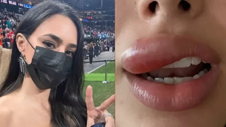 Entenda a condição que causou inchaço na boca de Bruna Biancardi