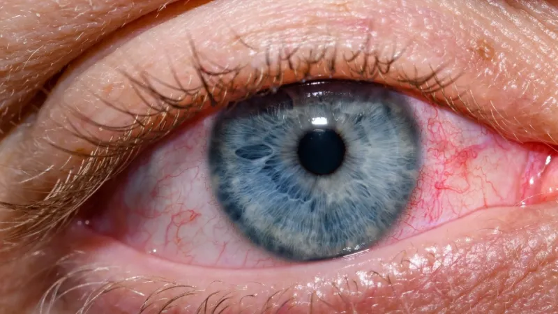Nova moda nas redes sociais leva homens a raspar os cílios e preocupa especialistas que alertam para riscos à saúde ocular