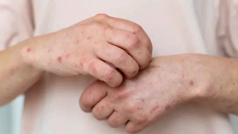 Casos de Mpox no Brasil: sintomas podem surgir na pele, mucosas e olhos