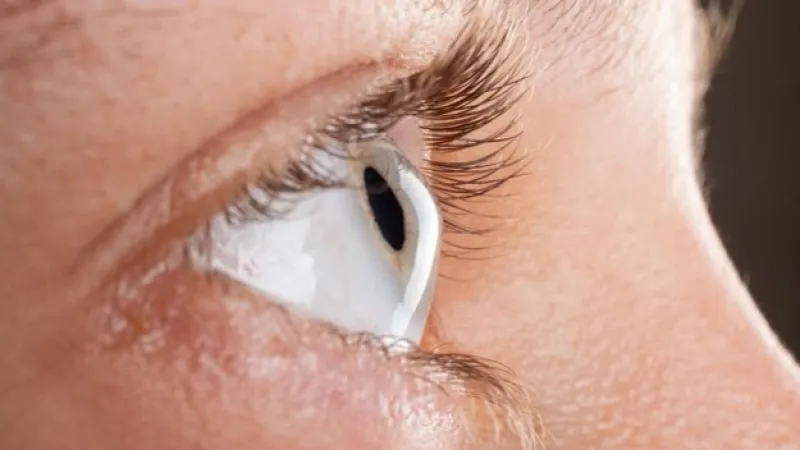 4 fatores de risco para o Ceratocone, entre eles coçar os olhos
