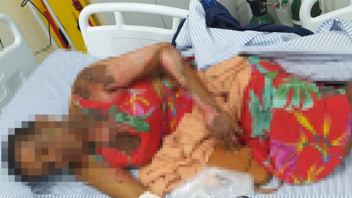Mulher que teve 70% do corpo queimado pelo companheiro morre no HGE, em Maceió
