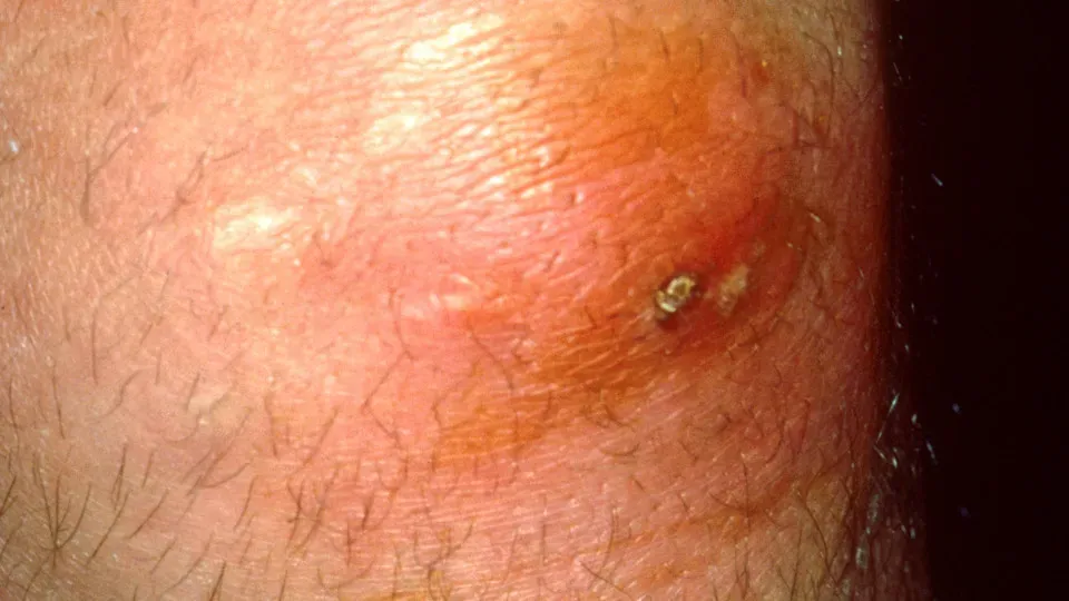 Furúnculo pode matar? Dermatologista alerta sobre riscos